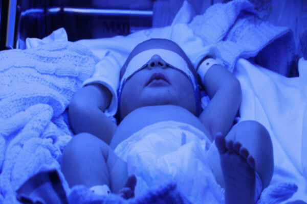 Ventajas de la fototerapia neonatal