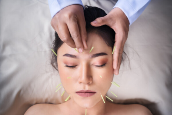 Beneficios de la acupuntura para el dolor de cabeza