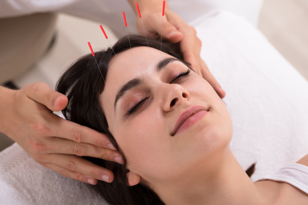 Beneficios de la acupuntura facial